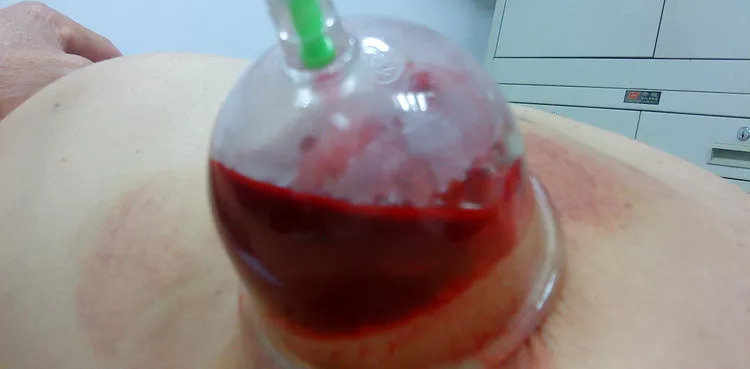 中醫(yī)帶狀皰疹是什么原因引起的,中醫(yī)視角下的帶狀皰疹成因及全面治療策略,快速問(wèn)題設(shè)計(jì)方案_視頻版17.39.14