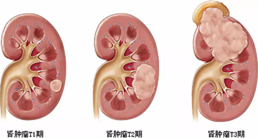 女性咽喉癌的早期癥狀圖片,關(guān)于女性咽喉癌的早期癥狀圖片及專業(yè)解答的問(wèn)題,清晰計(jì)劃執(zhí)行輔導(dǎo)_冒險(xiǎn)款33.14.39