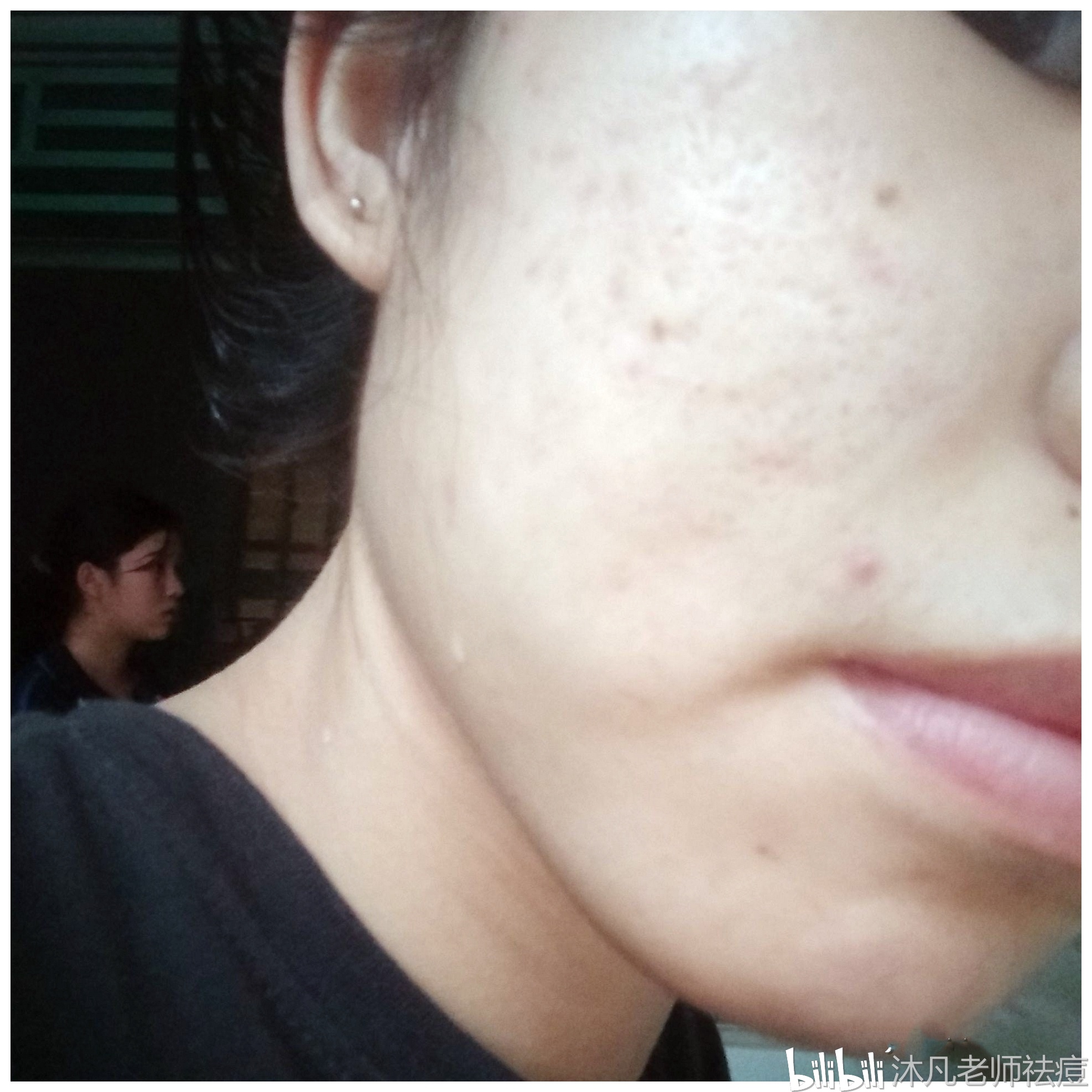 如何去痘印效果最好,如何去痘印效果最好，實地評估策略XE版,實地驗證數(shù)據(jù)設(shè)計_Galaxy17.57.34